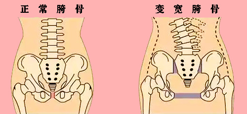 女人胯骨增宽怎么解决？